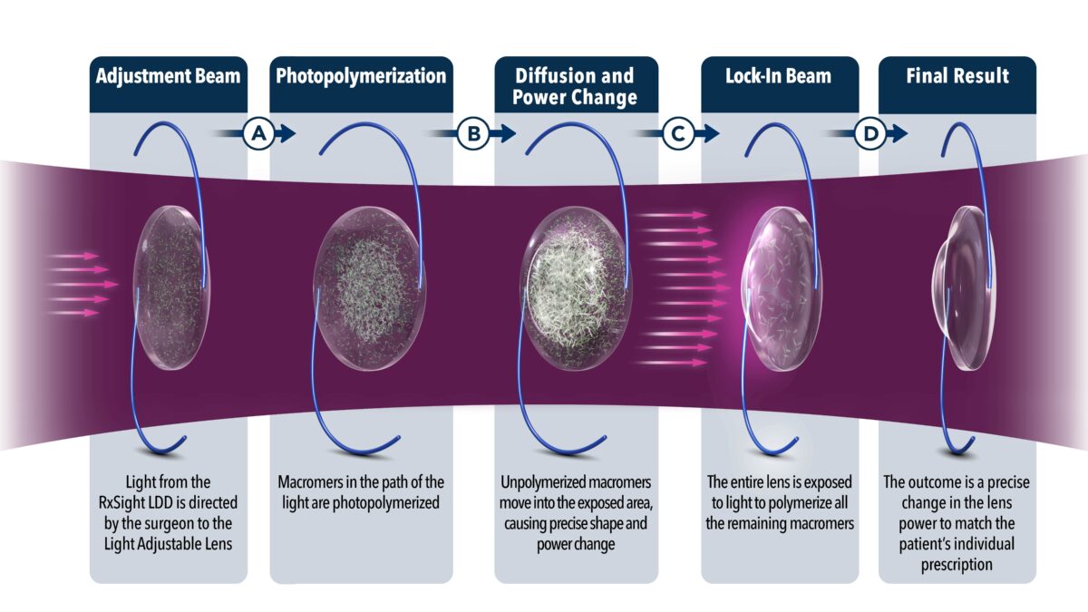 Refractive Lens Exchange St Louis RLE