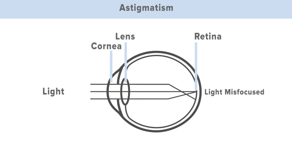 diagram of astigmatism