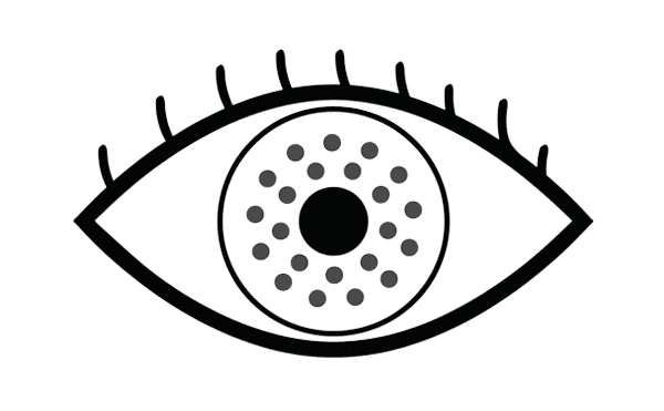 LASIK